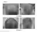 Fig. 06 - A PHARMACEUTICAL COMPOSITION COMPRISING A SUSPENSION OF TOTAL CELLS OBTAINED FROM HAIR FOLLICLE AND PLASMA DERIVED GROWTH FACTORS FOR PROMOTING HAIR FOLLICLE REGENERATION