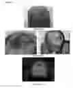 Fig. 07 - A PHARMACEUTICAL COMPOSITION COMPRISING A SUSPENSION OF TOTAL CELLS OBTAINED FROM HAIR FOLLICLE AND PLASMA DERIVED GROWTH FACTORS FOR PROMOTING HAIR FOLLICLE REGENERATION