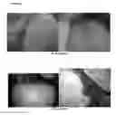 Fig. 08 - A PHARMACEUTICAL COMPOSITION COMPRISING A SUSPENSION OF TOTAL CELLS OBTAINED FROM HAIR FOLLICLE AND PLASMA DERIVED GROWTH FACTORS FOR PROMOTING HAIR FOLLICLE REGENERATION