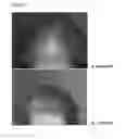 Fig. 09 - A PHARMACEUTICAL COMPOSITION COMPRISING A SUSPENSION OF TOTAL CELLS OBTAINED FROM HAIR FOLLICLE AND PLASMA DERIVED GROWTH FACTORS FOR PROMOTING HAIR FOLLICLE REGENERATION