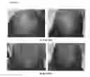 Fig. 10 - A PHARMACEUTICAL COMPOSITION COMPRISING A SUSPENSION OF TOTAL CELLS OBTAINED FROM HAIR FOLLICLE AND PLASMA DERIVED GROWTH FACTORS FOR PROMOTING HAIR FOLLICLE REGENERATION