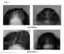 Fig. 11 - A PHARMACEUTICAL COMPOSITION COMPRISING A SUSPENSION OF TOTAL CELLS OBTAINED FROM HAIR FOLLICLE AND PLASMA DERIVED GROWTH FACTORS FOR PROMOTING HAIR FOLLICLE REGENERATION