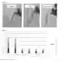 Fig. 03 - Methods for cross-linking corneal collagen with verteporfin for the treatment of disorders of the eye