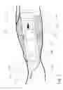 Fig. 03 - ENHANCED CANNULATION METHOD AND NEEDLES