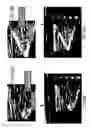 Fig. 08 - ECHOGENIC PATTERN AND MEDICAL ARTICLES INCLUDING SAME