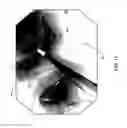 Fig. 11 - Center marker for dilatation balloon
