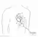 Fig. 01 - Epicardial defibrilation lead with side helix fixation and placement thereof