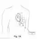 Fig. 02 - Epicardial defibrilation lead with side helix fixation and placement thereof