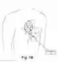 Fig. 03 - Epicardial defibrilation lead with side helix fixation and placement thereof