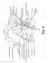 Fig. 06 - Epicardial defibrilation lead with side helix fixation and placement thereof