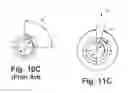 Fig. 14 - Epicardial defibrilation lead with side helix fixation and placement thereof