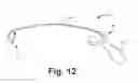 Fig. 15 - Epicardial defibrilation lead with side helix fixation and placement thereof