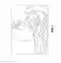 Fig. 02 - SYSTEM AND METHOD FOR IMPLANTATION OF LEAD AND ELECTRODES TO THE ENDOPELVIC PORTION OF THE PELVIC NERVES AND CONNECTION CABLE FOR ELECTRODE WITH DIRECTION MARKER