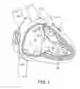 Fig. 02 - INTERVENTIONAL MEDICAL SYSTEMS AND CATHETERS