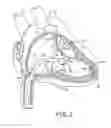 Fig. 03 - INTERVENTIONAL MEDICAL SYSTEMS AND CATHETERS