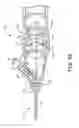Fig. 09 - INTERVENTIONAL MEDICAL SYSTEMS AND CATHETERS