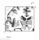 Fig. 07 - User interface with 3D environment for configuring stimulation therapy