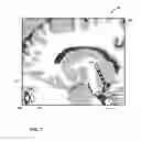 Fig. 08 - User interface with 3D environment for configuring stimulation therapy