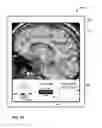 Fig. 35 - User interface with 3D environment for configuring stimulation therapy