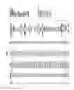 Fig. 08 - METHODS OF PREDICTING MEDICALLY REFRACTIVE ULCERATIVE COLITIS (mrUC) REQUIRING COLECTOMY