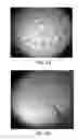 Fig. 45 - Method for treating cell proliferation related disorders