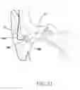 Fig. 23 - Ear mold for auditory device