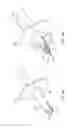 Fig. 10 - Percutaneous atrial and ventricular septal defect closure device