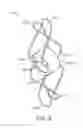 Fig. 15 - Percutaneous atrial and ventricular septal defect closure device