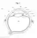 Fig. 02 - Surgical apparatus and method of use thereof