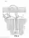 Fig. 03 - Tensionable constructs with multi-limb locking mechanism through single splice and methods of tissue repair