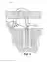 Fig. 03 - Tensionable constructs with multi-limb locking mechanism through single splice and methods of tissue repair