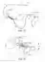 Fig. 04 - Apparatus for mitral valve repair and methods thereof