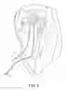 Fig. 07 - Apparatus for mitral valve repair and methods thereof