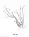 Fig. 10 - Apparatus for mitral valve repair and methods thereof