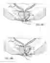 Fig. 10 - Latching anchor device