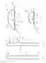 Fig. 02 - Suture and soft anchor assembly and method of making the same