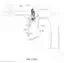 Fig. 135 - Surgical stapler for aortic anastomosis