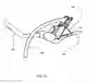 Fig. 48 - Surgical stapler for aortic anastomosis