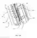 Fig. 86 - Surgical stapler for aortic anastomosis