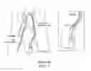 Fig. 02 - MULTIPLE OCCLUDER DELIVERY DEVICES AND METHODS