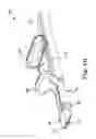 Fig. 09 - Introducer with tissue pocket optimizer
