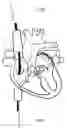 Fig. 01 - SYSTEM AND METHOD FOR TREATING HEPATIC AREA VEIN OCCLUSION
