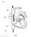 Fig. 03 - SYSTEM AND METHOD FOR TREATING HEPATIC AREA VEIN OCCLUSION