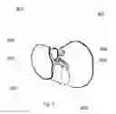 Fig. 08 - SYSTEM AND METHOD FOR TREATING HEPATIC AREA VEIN OCCLUSION