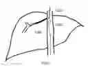 Fig. 16 - SYSTEM AND METHOD FOR TREATING HEPATIC AREA VEIN OCCLUSION