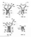 Fig. 17 - SURGICAL PORT ASSEMBLY