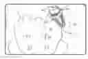 Fig. 01 - Method for deploying a fusion device for sacroiliac joint fusion