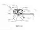 Fig. 17 - System and method for altering rotational alignment of bone sections