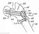 Fig. 01 - Bone end (epiphysis) fracture fixation device and method of use