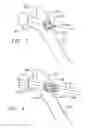 Fig. 03 - Bone end (epiphysis) fracture fixation device and method of use